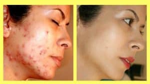 acne removal treatment near me