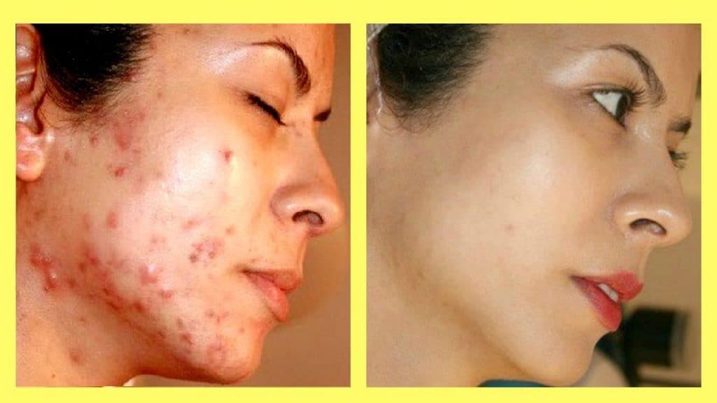 Acne Scars Treatment in Islamabad Rawalpindi | Pimples Treatment