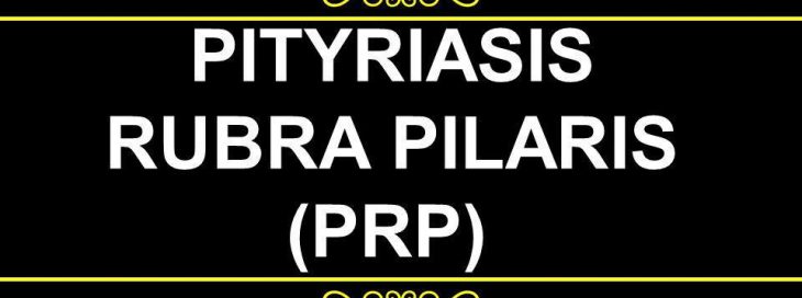TOP DERMATOLOGIST PRESENTED A CASE STUDY OF ERYTHRODERMA DUE TO PITYRIASIS RUBRA PILARI