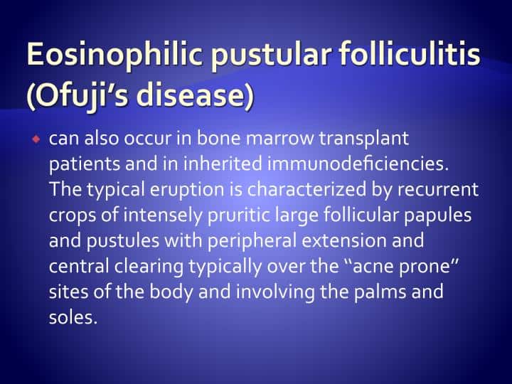 BEST SKIN SPECIALIST TALKS ABOUT EOSINOPHILIC PUSTULAR FOLLICULITIS OF OFUJI IN AN IMMUNOCOMPETENT (NON-HIV) PAKISTANI PATIENT