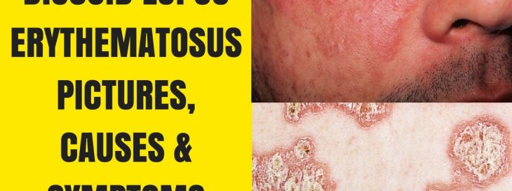 SEBACEOUS GRANULOMAS: A NOVEL FEATURE OF DISCOID LUPUS ERYTHEMATOSUS – CASE STUDY BY THE BEST SKIN SPECIALIST IN ISLAMABAD PAKISTAN