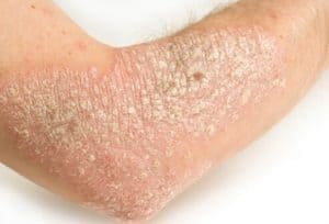 psoriasis