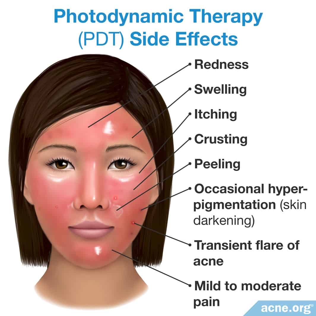 Skin Cancer Treatment Photodynamic