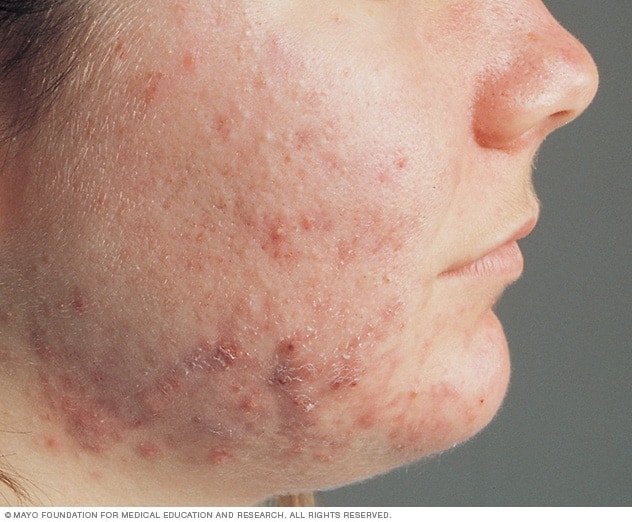 Acne Types, Causes and Preventions