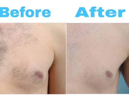 Hair Removal Treatment - Best Dermatologist In Islamabad