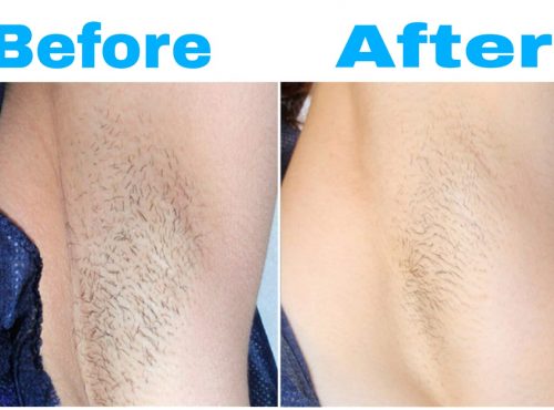 Hair Removal Treatment - Best Skin Specialist In Islamabad
