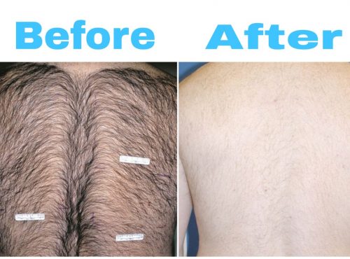 Laser Hair Removal - Best Skin Specialist In Islamabad