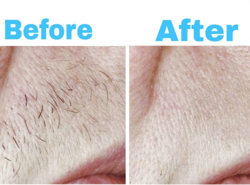 Results of Hair Removal - Best Skin Specialist In Islamabad
