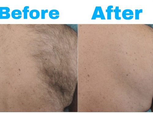 Results of Hair Removal - Prof. Dr. Ikram Ullah Khan