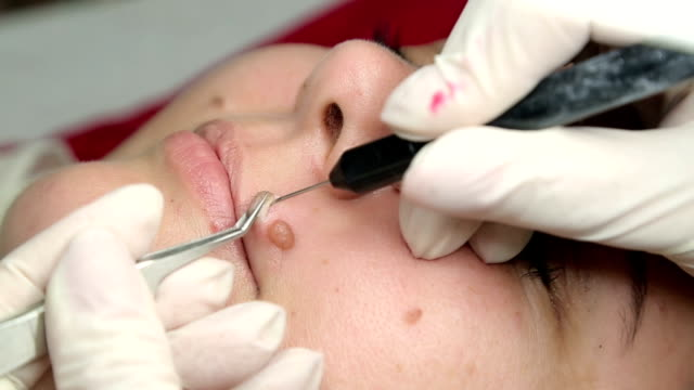 Shave Removal for Mole Removal