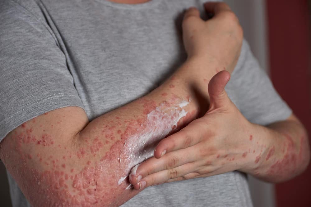 Seborrheic Dermatitis