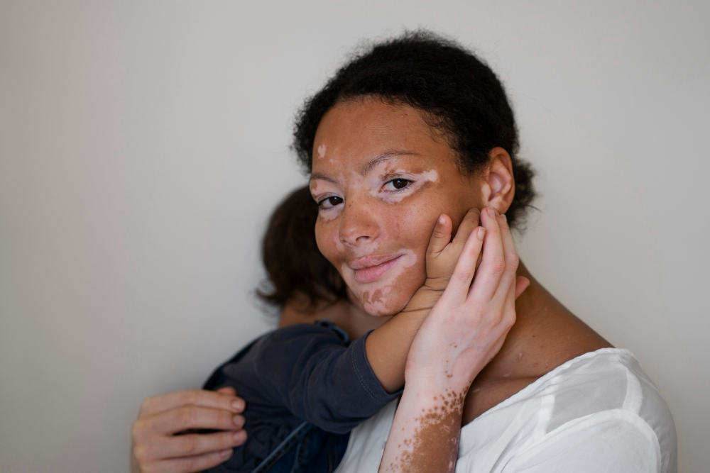 vitiligo