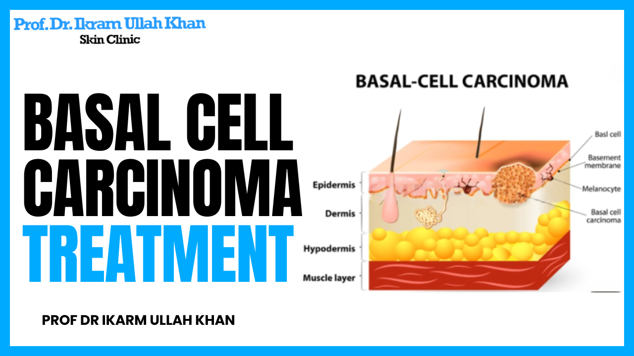 Basal Cell Carcinoma Laser Treatment by Prof Dr Ikram Ullah Khan