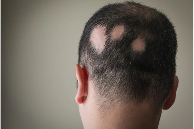 patchy alopecia areata